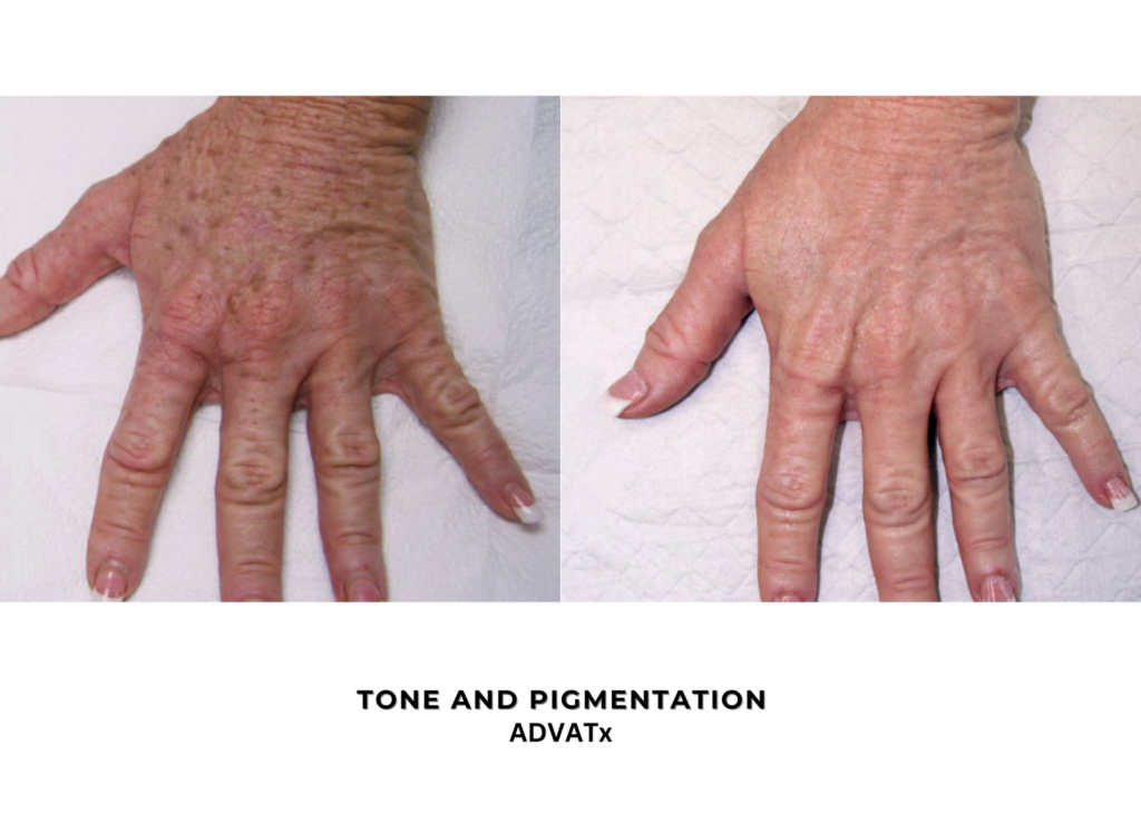 #2 TONE AND PIGMENTATION - ADVATX