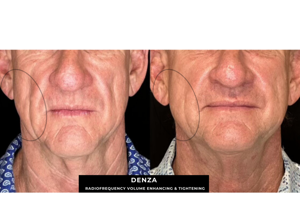 DENZA RF SKIN TIGHTENING