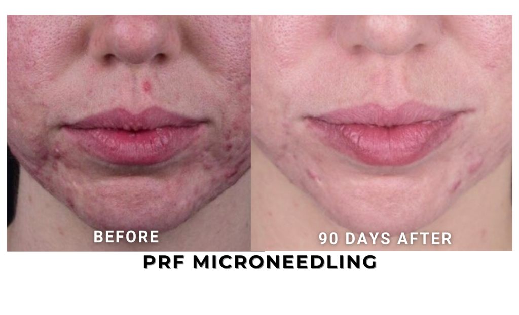 PRF MICRONEEDLING